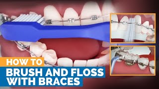 How to Brush amp Floss with Braces [upl. by Wiburg]