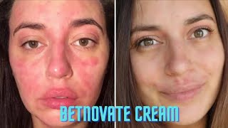 Betnovate cream  Uses of betnovate [upl. by Loggins]