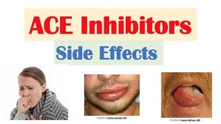 ACE Inhibitor Side Effects Lisinopril Ramipril Captopril Perindopril  Causes and Why They Occur [upl. by Eniamrahc]