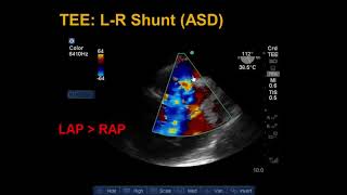 Systemic Vascular Resistance Total Peripheral Resistance  Cardiology [upl. by Fasa732]