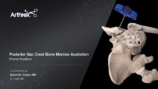 Posterior Iliac Crest Bone Marrow Aspiration  Prone Position [upl. by Aiclef139]