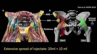 Pericapsular Nerve Group PENG block for hip analgesia [upl. by Aniz]