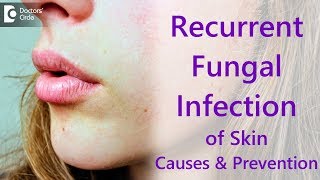 Why do i get recurrent fungal skin infections  Dr Amee Daxini [upl. by Htrowslle]