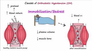 Orthostatic Hypotension Described Concisely [upl. by Ykcub]