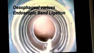 Endoscopic Band Ligation of oesophageal varices [upl. by Rheims]