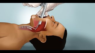 Extubation and first breaths after double lung transplant  Cystic Fibrosis [upl. by Heiskell]