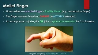 Mallet Finger Hindi [upl. by Crow]