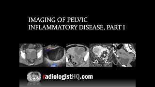 Imaging of Pelvic Inflammatory Disease Part I [upl. by Yojal322]