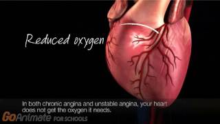 An Overview of Angina [upl. by Eisse]