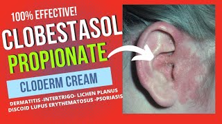 CLOBESTASOL PROPIONATE CREAM REVIEW [upl. by Ahsenit]