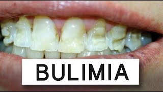 What Bulimia Does To Your Mouth [upl. by Mathilda]