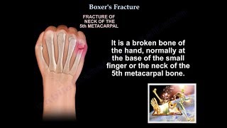 Boxers Fracture  Everything You Need To Know  Dr Nabil Ebraheim [upl. by Werdnael]