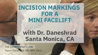 Where Are Incision Lines for a Mini Facelift Dr Daneshrads Approach [upl. by Bergin330]