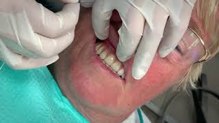 How flossing ALLON4 implants works [upl. by Glogau]