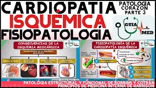 CARDIOPATÍA ISQUÉMICA FISIOPATOLOGÍA  GuiaMed [upl. by Card796]