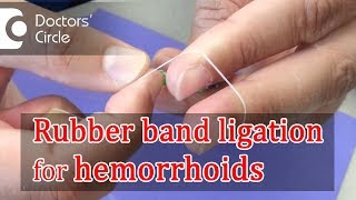 What is Rubber Band Ligation  Dr Rajasekhar M R [upl. by Ochs136]