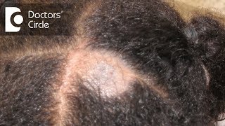 What causes Scalp Ringworm Effective Treatment   Tinea Capitis  Dr Tina Ramachander [upl. by Ailecra]