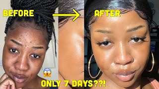 HOW I CLEARED MY SKIN in 1 WEEK and LIGHTENED my dark under eye circles [upl. by Riordan]