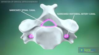 Cervical Osteochondrosis Definition [upl. by Yelra666]