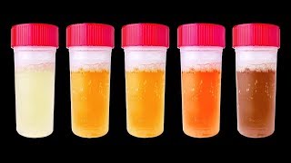 7 Choses Que Ton Urine Peut Révéler Sur ta Santé [upl. by Tennes]