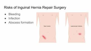 Inguinal Hernia Repair Surgery Risks and Outcomes  CHI Health [upl. by Dleifxam333]