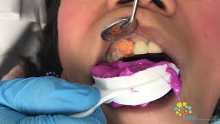 Cosmetic Dental Crown Procedure  All Ceramic Crown [upl. by Eulaliah]