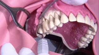 Periodontal surgery Modified Widmann flap [upl. by Hayse]