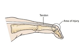 Greensboro Orthopaedics Mallet Finger Splint Application amp Removal with Jennifer Sexton OTRL CHT [upl. by Ellata]