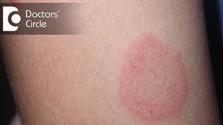 How to manage Chronic Ringworm infection  Dr Rajdeep Mysore [upl. by Ahsinaw]