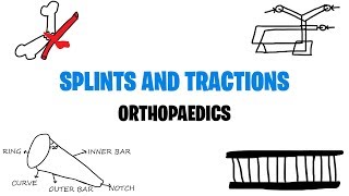 SPLINTS AND TRACTIONS  ORTHOPAEDICS  MED VIDS MADE SIMPLE [upl. by Mauretta]